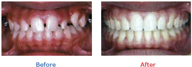 空隙歯列の症例